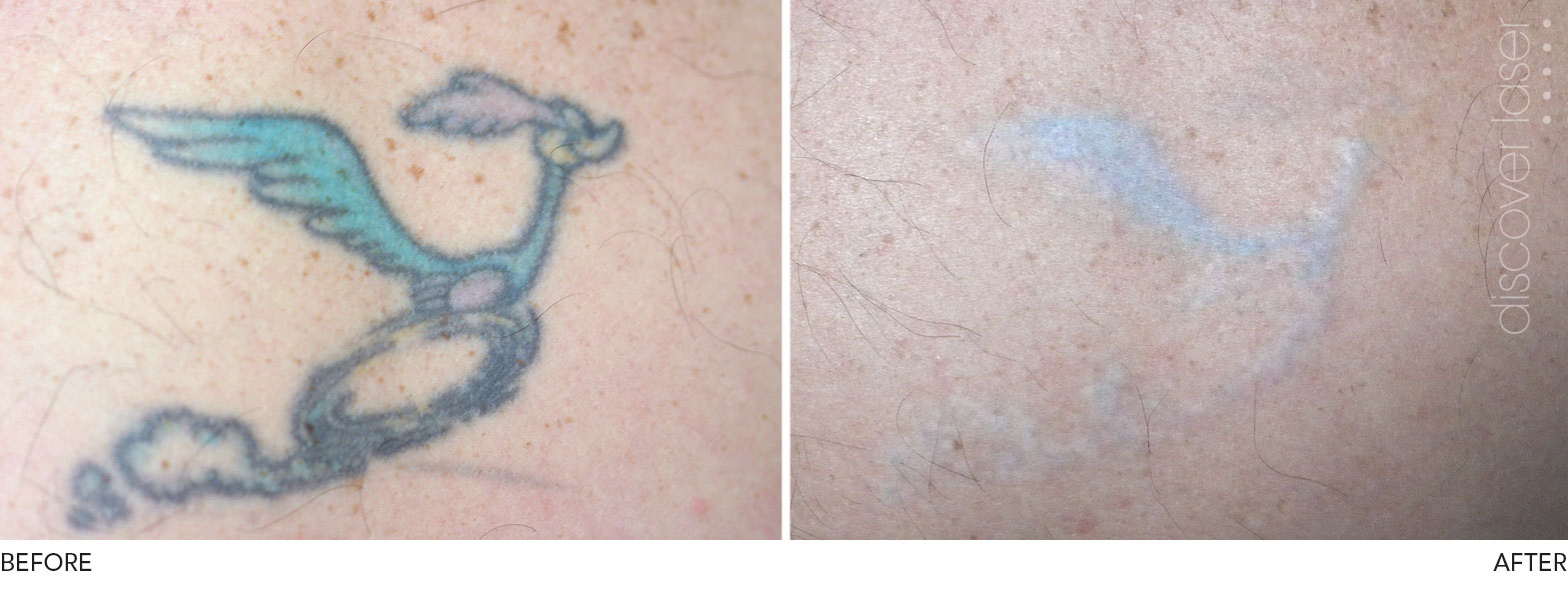 Laser Tattoo Removal - Cosmetic Clinic Burnley Lancashire