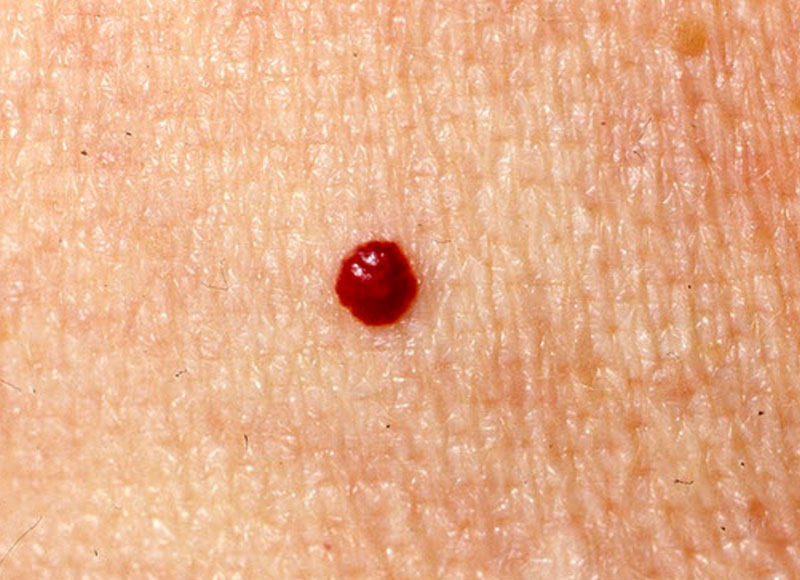 Spot Removal Spot Removal Blood