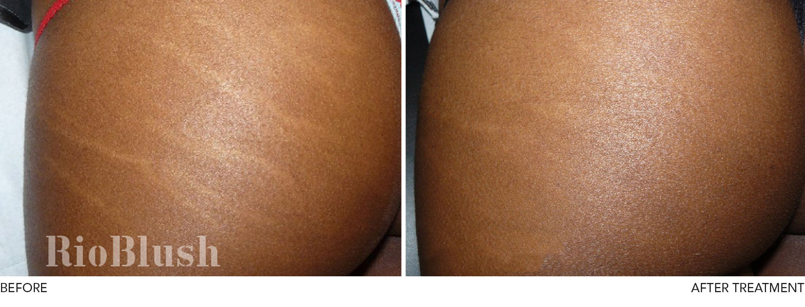 Stretch Marks - Aesthetic Clinic Burnley Lancashire