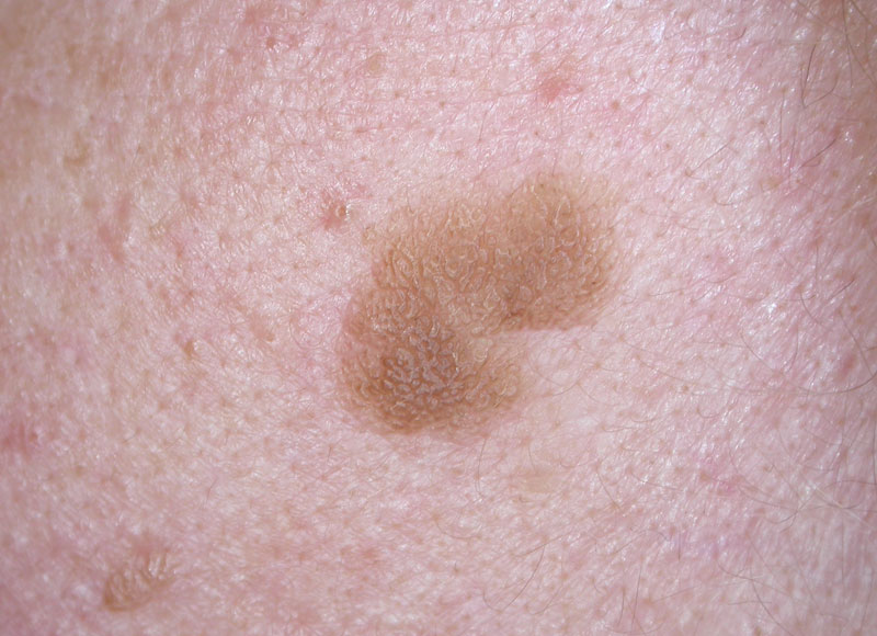 Body blemish removal - skin tags, moles &amp; warts 