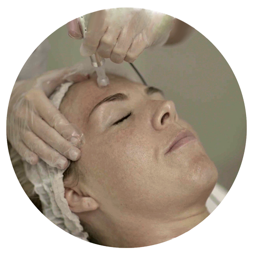 Step 1 Microneedling