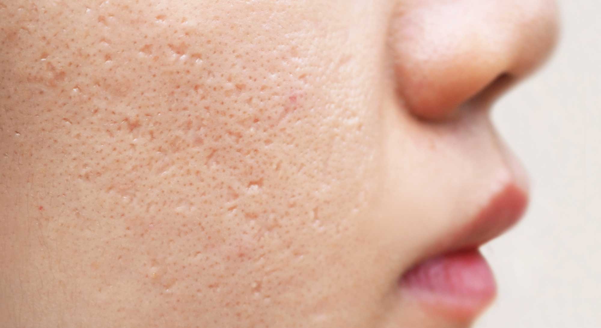 acne-treatment Private clinical setting