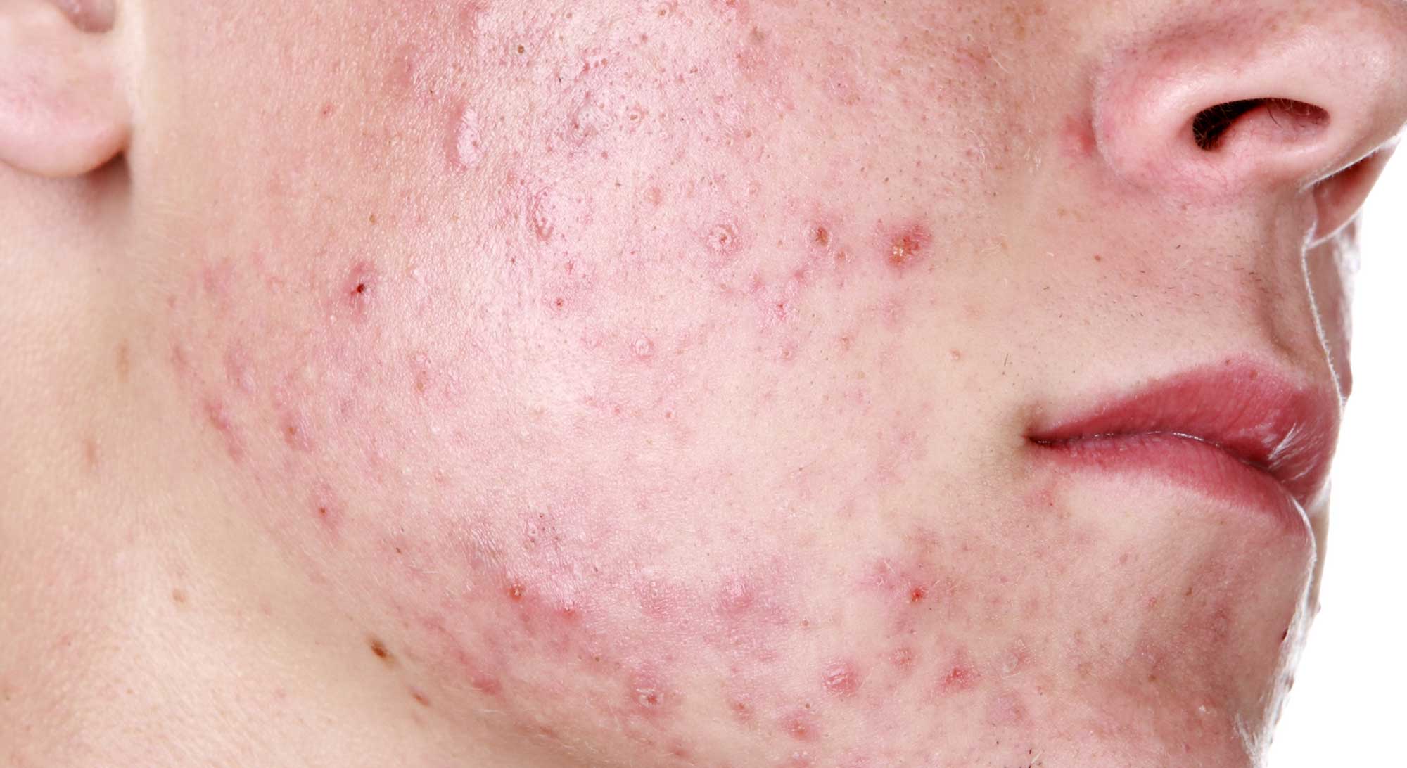 severe-acne
